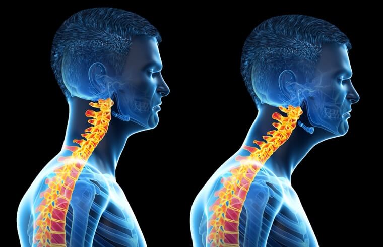 head-posture